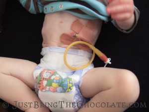 Malecot ube used as a gastrostomy feeding tube